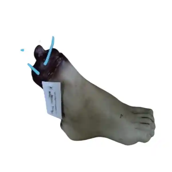 Scary Broken Foot